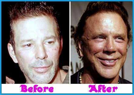 mickey-rourke-plastic-surgery-before-after.jpg - Click image for larger version  Name:	mickey-rourke-plastic-surgery-before-after.jpg Views:	13 Size:	41.4 KB ID:	17791974
